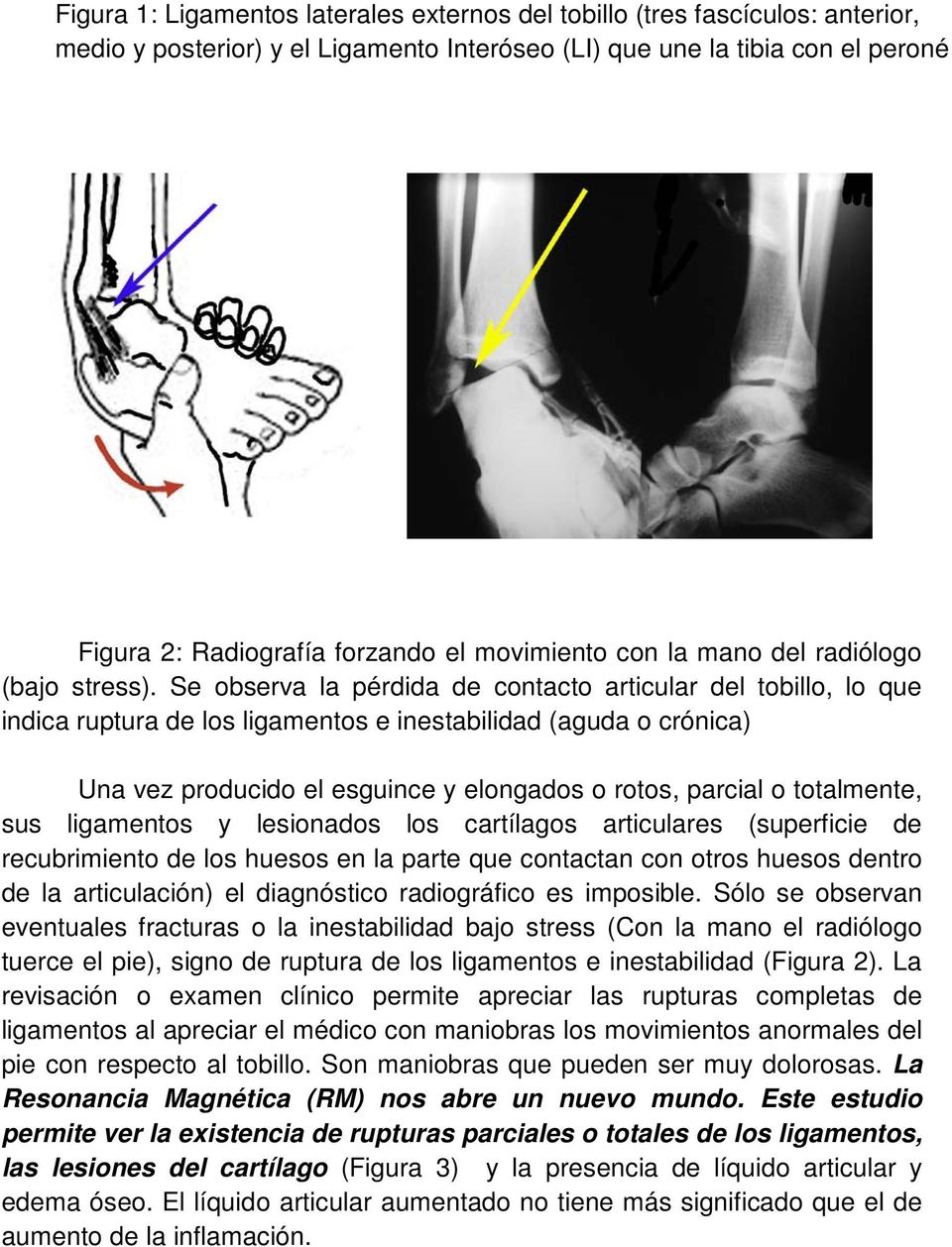 Se observa la pérdida de contacto articular del tobillo, lo que indica ruptura de los ligamentos e inestabilidad (aguda o crónica) Una vez producido el esguince y elongados o rotos, parcial o
