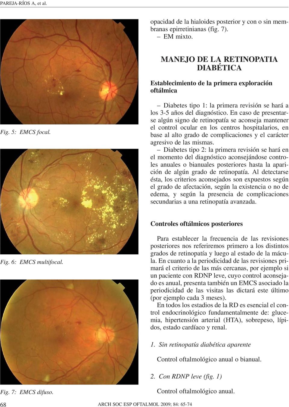En caso de presentarse algún signo de retinopatía se aconseja mantener el control ocular en los centros hospitalarios, en base al alto grado de complicaciones y el carácter agresivo de las mismas.