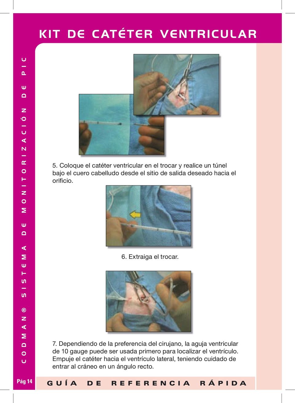 Dependiendo de la preferencia del cirujano, la aguja ventricular de 10 gauge puede ser usada primero