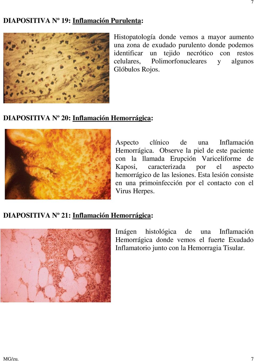 Observe la piel de este paciente con la llamada Erupción Variceliforme de Kaposi, caracterizada por el aspecto hemorrágico de las lesiones.