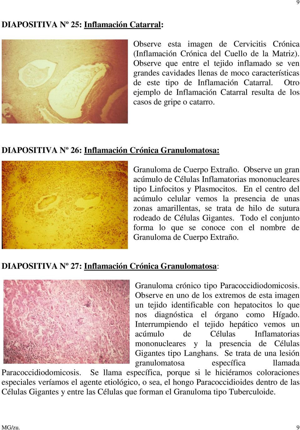 Otro ejemplo de Inflamación Catarral resulta de los casos de gripe o catarro. DIAPOSITIVA Nº 26: Inflamación Crónica Granulomatosa: Granuloma de Cuerpo Extraño.