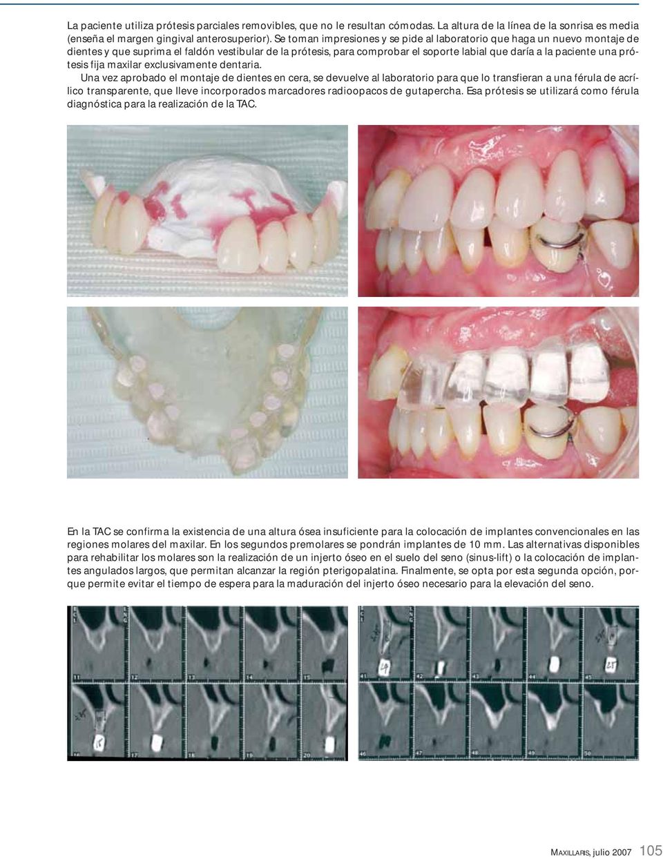 prótesis fija maxilar exclusivamente dentaria.