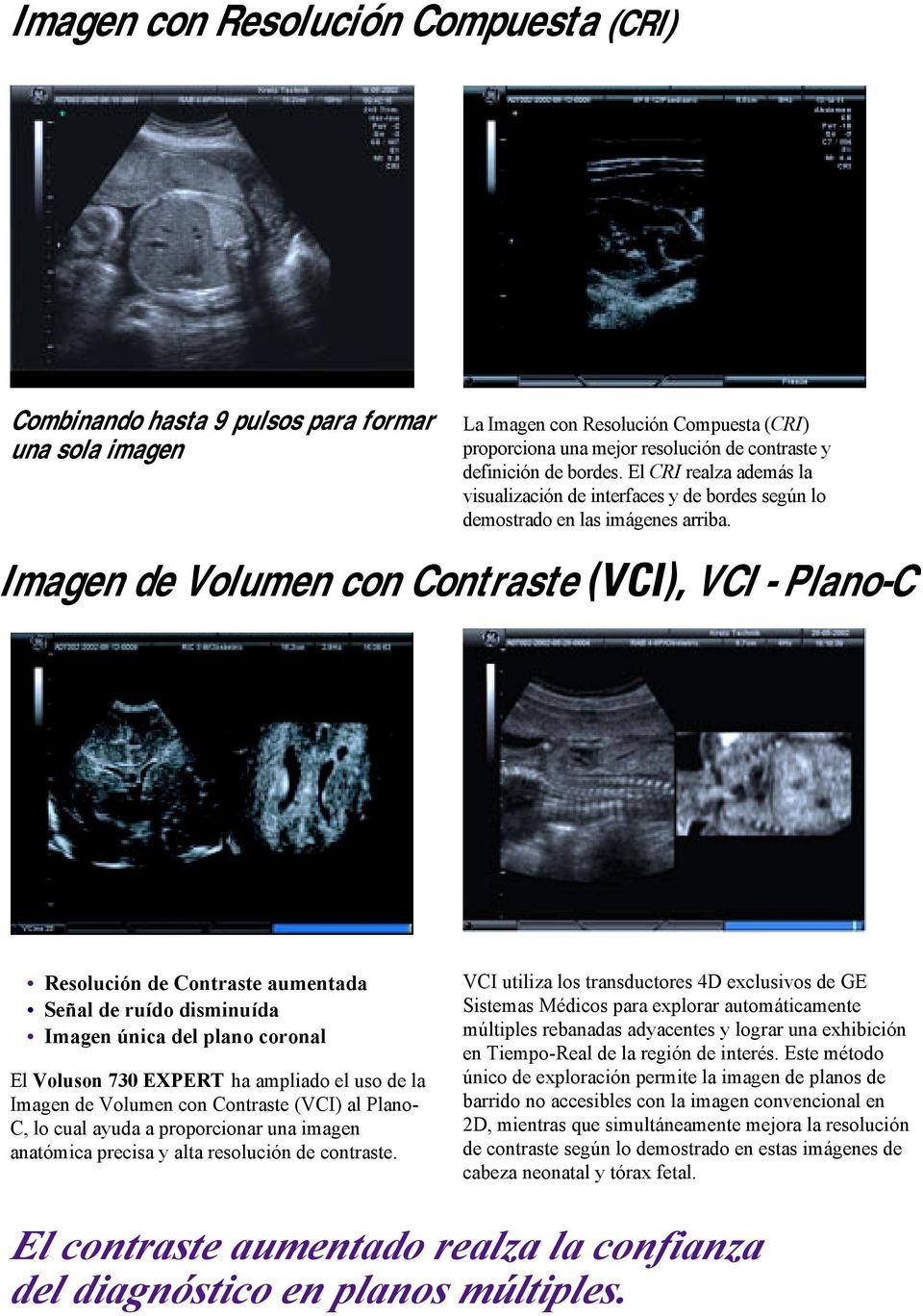 Imagen de Volumen con Contraste (VCI), VCI - Plano-C Resolución de Contraste aumentada Señal de ruído disminuída Imagen única del plano coronal El Voluson 730 EXPERT ha ampliado el uso de la Imagen
