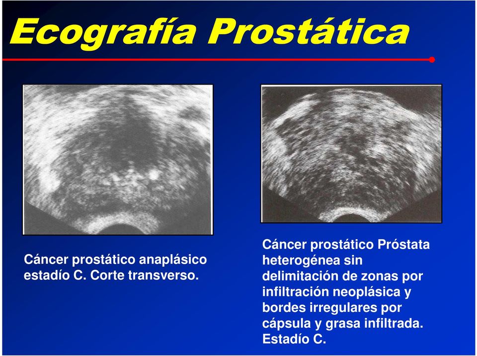 Cáncer prostático Próstata heterogénea sin