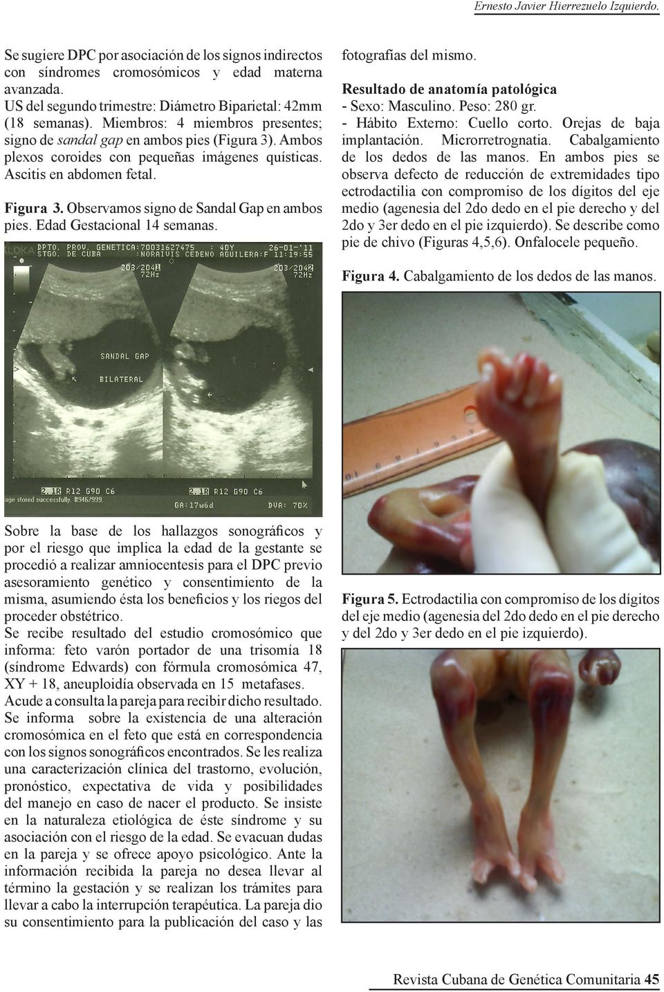 Ascitis en abdomen fetal. Figura 3. Observamos signo de Sandal Gap en ambos pies. Edad Gestacional 14 semanas. fotografías del mismo. Resultado de anatomía patológica - Sexo: Masculino. Peso: 280 gr.