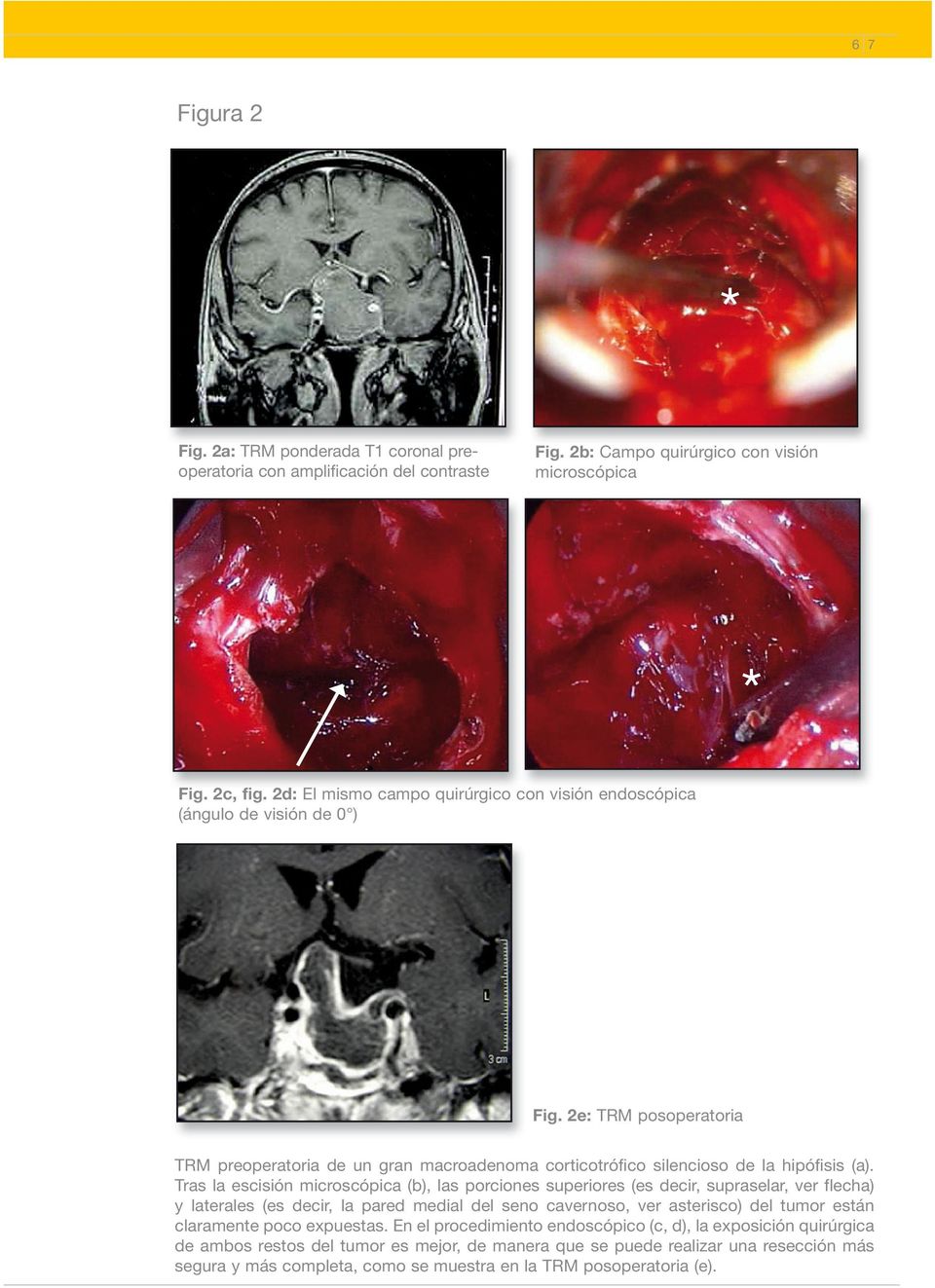 Tras la escisión microscópica (b), las porciones superiores (es decir, supraselar, ver flecha) y laterales (es decir, la pared medial del seno cavernoso, ver asterisco) del tumor están claramente