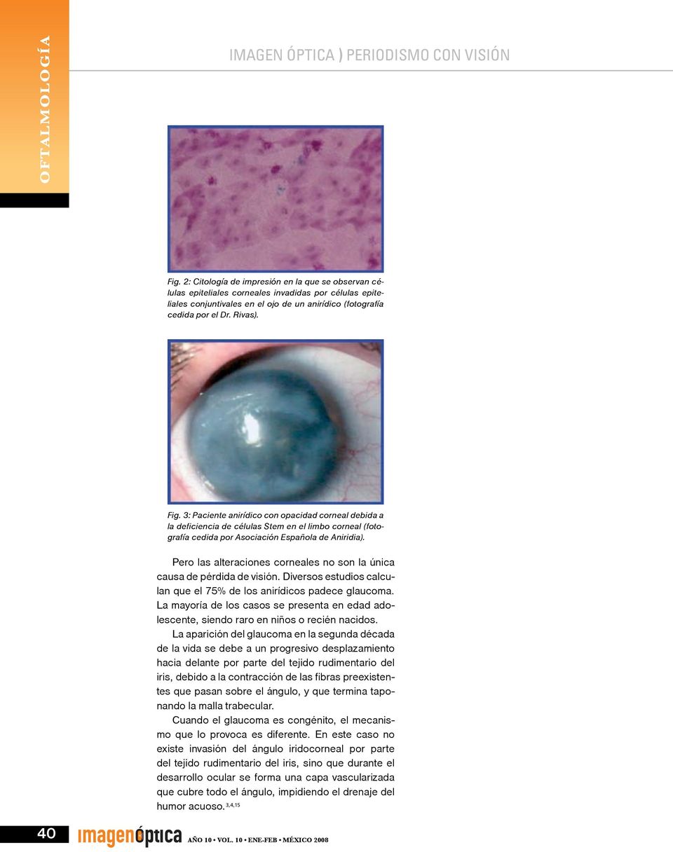 3: Paciente anirídico con opacidad corneal debida a la deficiencia de células Stem en el limbo corneal (fotografía cedida por Asociación Española de Aniridia).