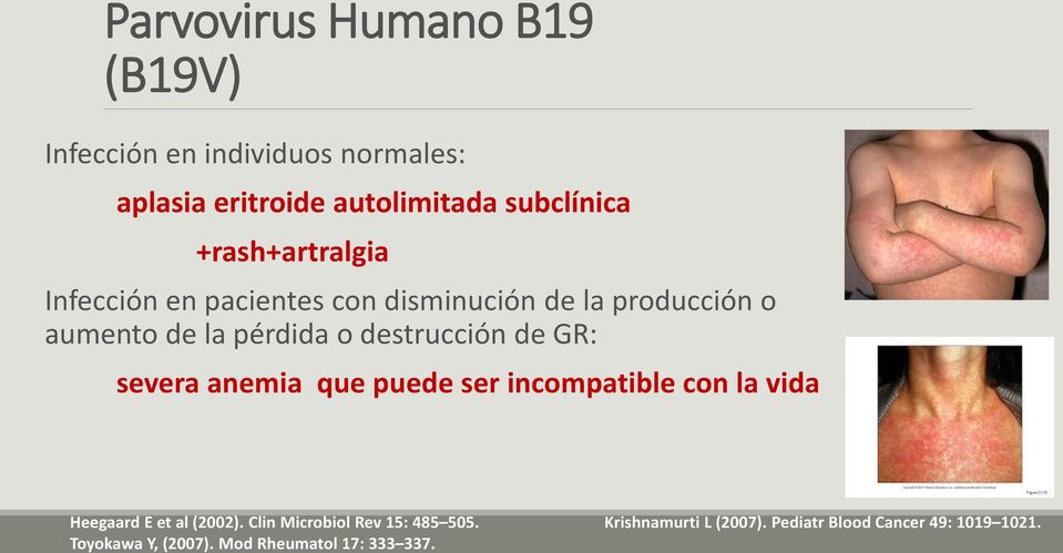 Parvovirus Humano B19 (B19V) Infección en individuos normales: aplasia eritroide autolimitada subclínica