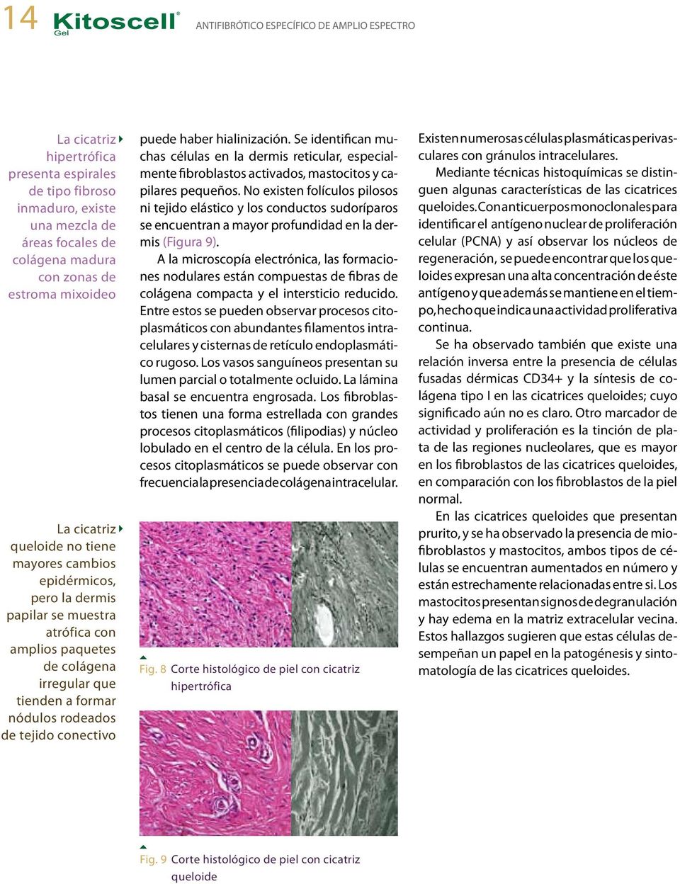 tejido conectivo puede haber hialinización. Se identifican muchas células en la dermis reticular, especialmente fibroblastos activados, mastocitos y capilares pequeños.