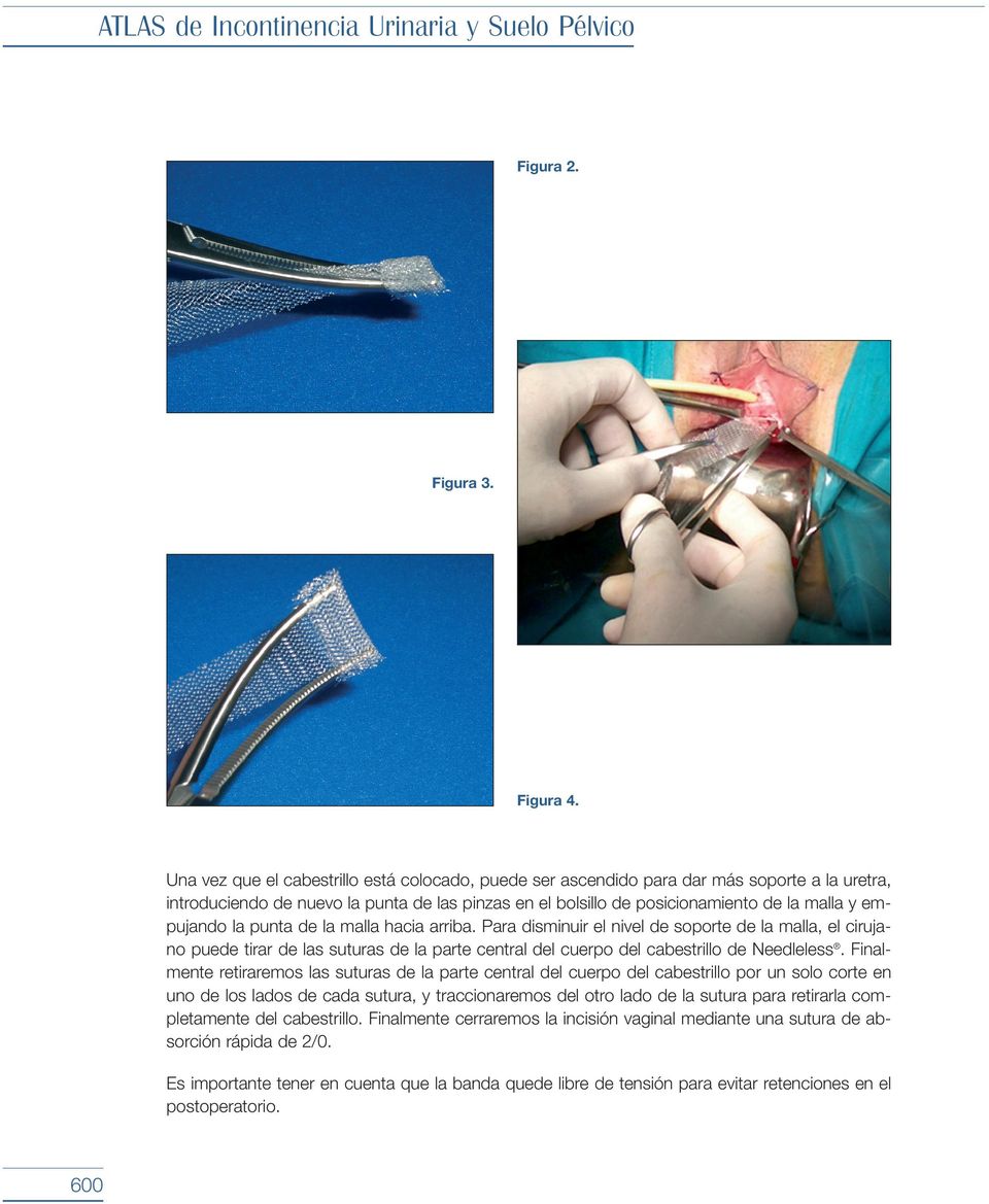 la punta de la malla hacia arriba. Para disminuir el nivel de soporte de la malla, el cirujano puede tirar de las suturas de la parte central del cuerpo del cabestrillo de Needleless.