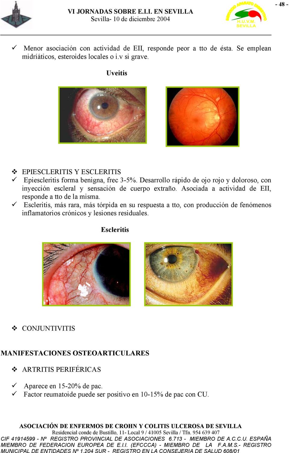 Desarrollo rápido de ojo rojo y doloroso, con inyección escleral y sensación de cuerpo extraño. Asociada a actividad de EII, responde a tto de la misma.