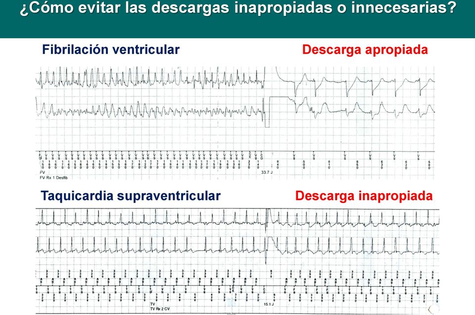 Fibrilación ventricular Descarga