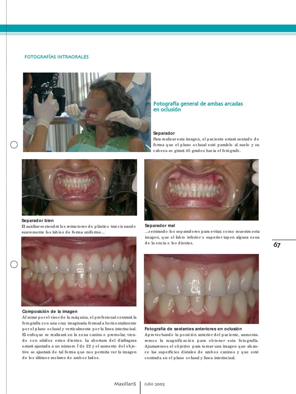 ..centrando los separadores para evitar, como muestra esta imagen, que el labio inferior o superior tapen alguna zona de la encía o los dientes.