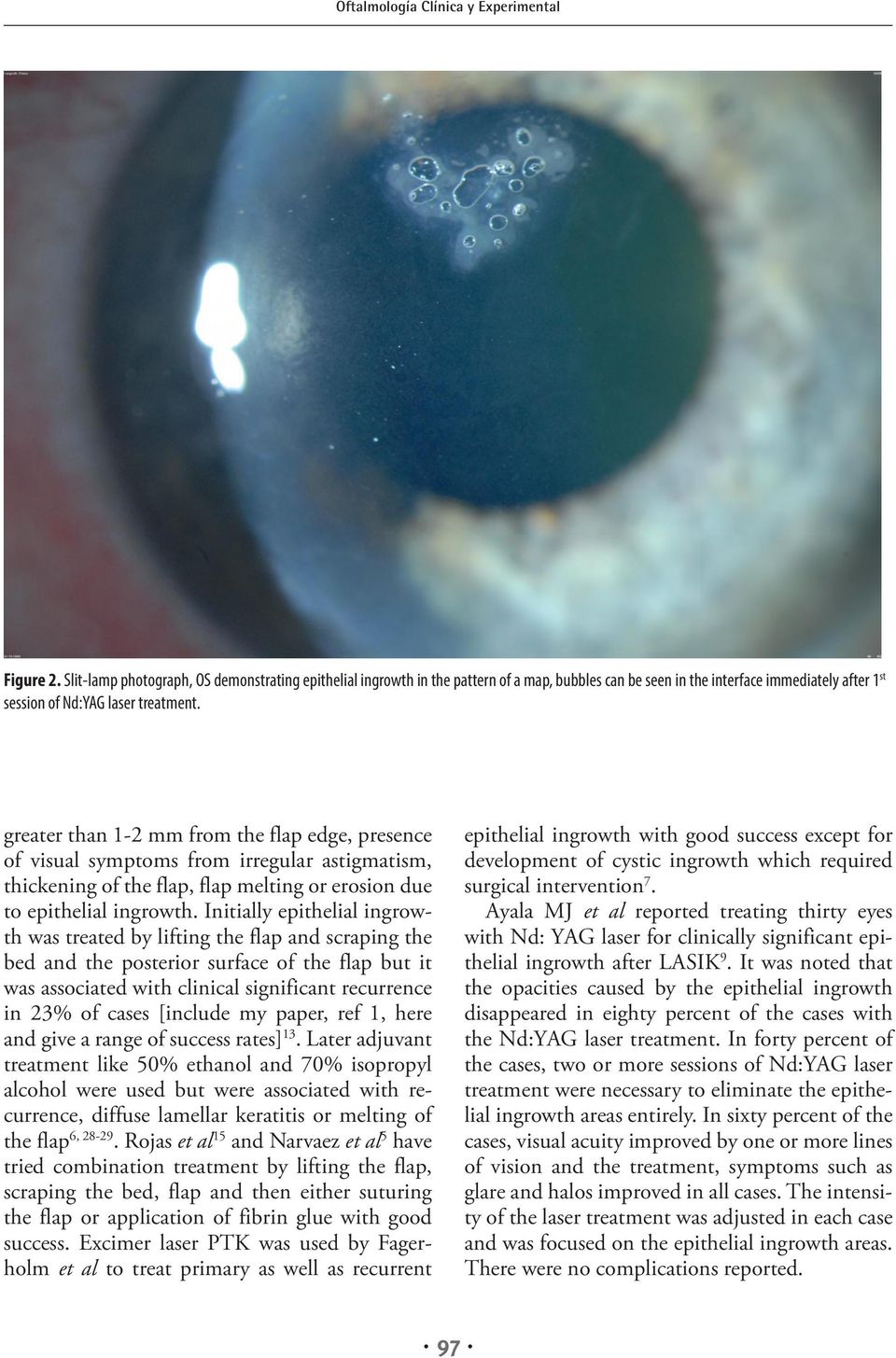 Initially epithelial ingrowth was treated by lifting the flap and scraping the bed and the posterior surface of the flap but it was associated with clinical significant recurrence in 23% of cases