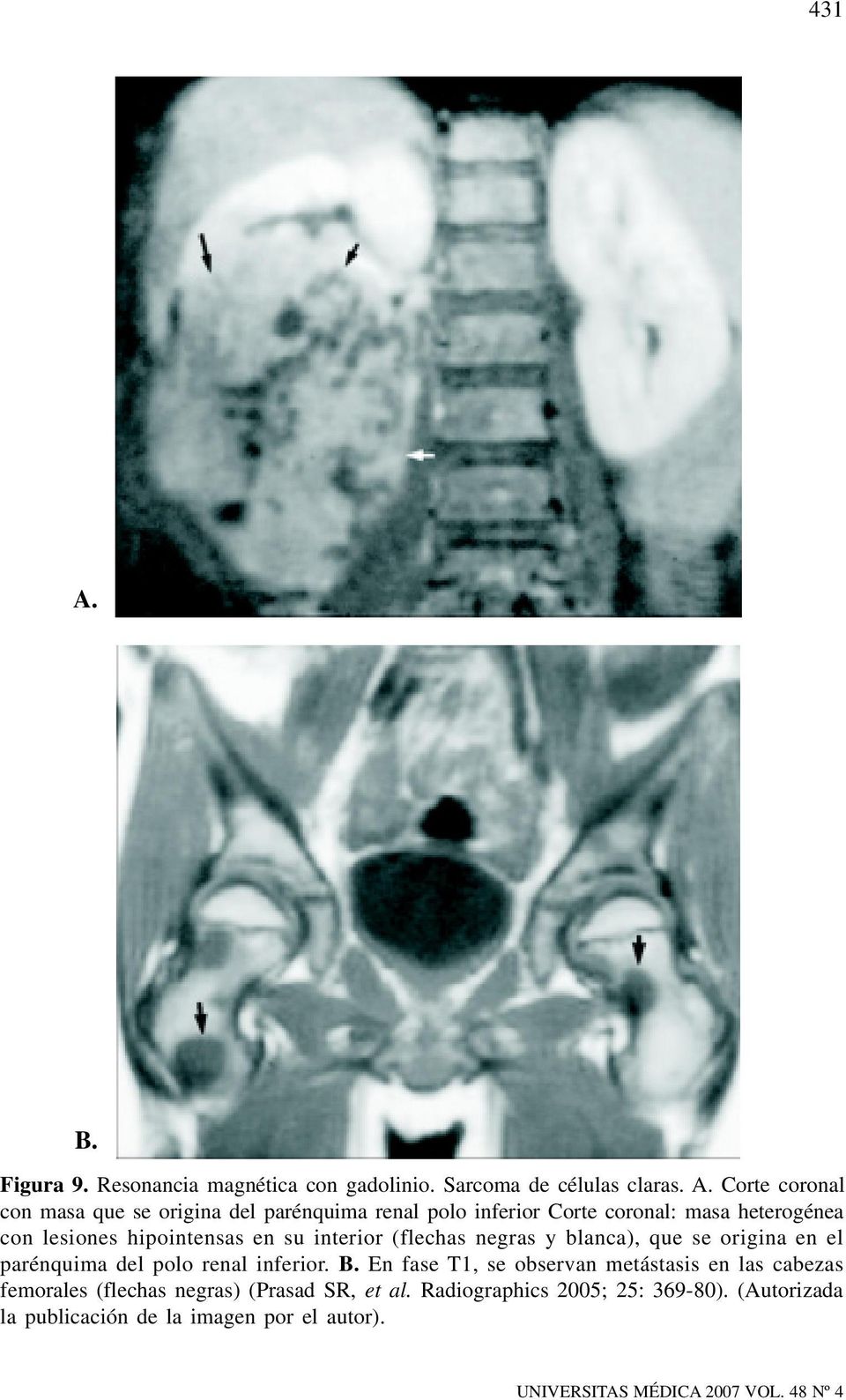 Corte coronal con masa que se origina del parénquima renal polo inferior Corte coronal: masa heterogénea con lesiones hipointensas en