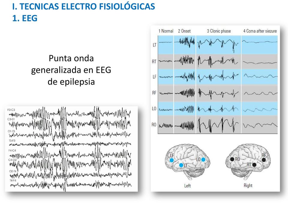 EEG Punta onda