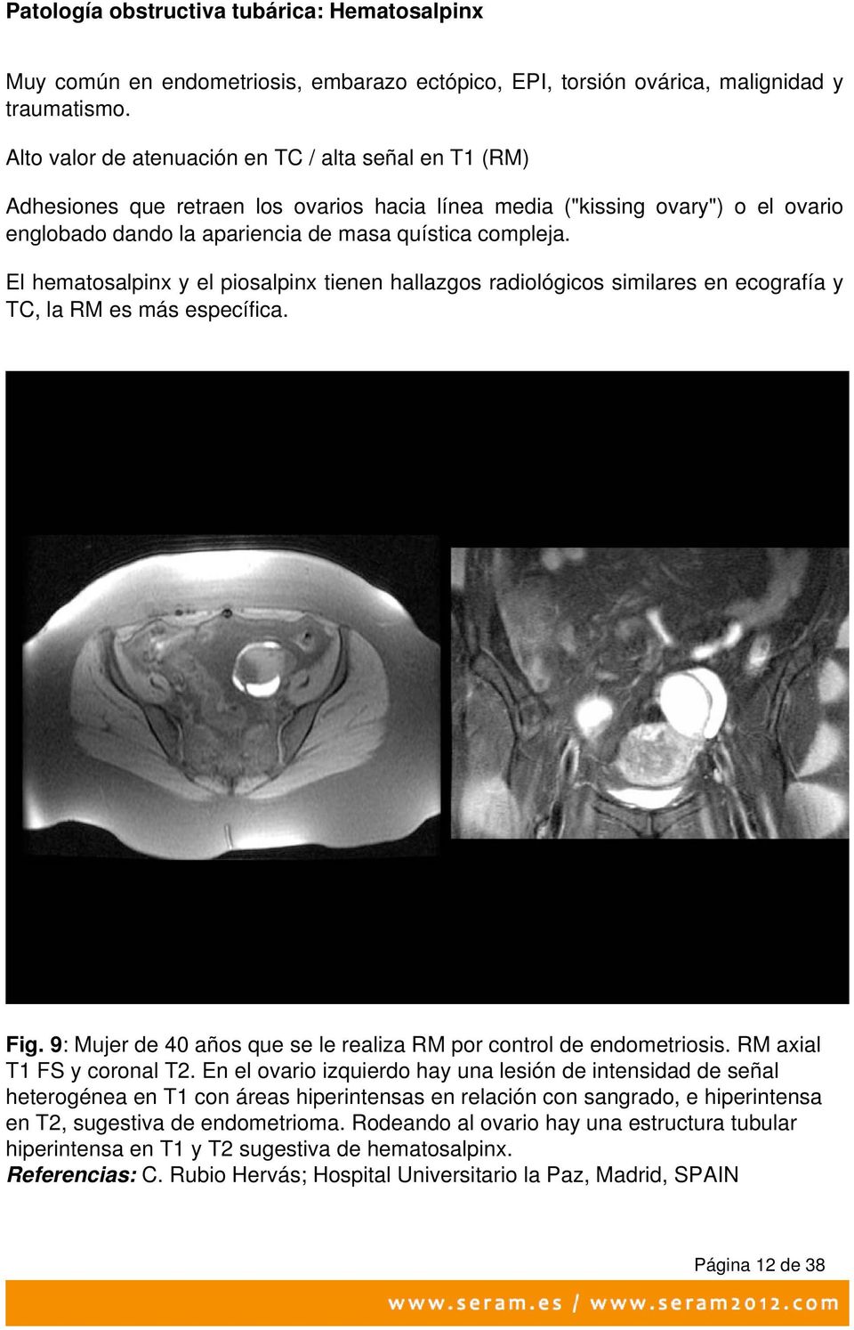 El hematosalpinx y el piosalpinx tienen hallazgos radiológicos similares en ecografía y TC, la RM es más específica. Fig. 9: Mujer de 40 años que se le realiza RM por control de endometriosis.