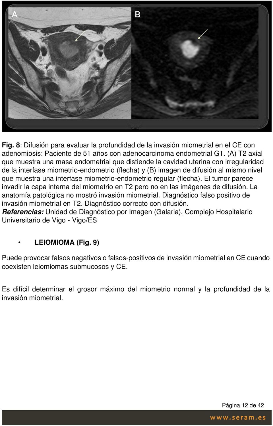 interfase miometrio-endometrio regular (flecha). El tumor parece invadir la capa interna del miometrio en T2 pero no en las imágenes de difusión. La anatomía patológica no mostró invasión miometrial.