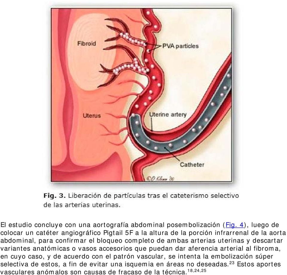 completo de ambas arterias uterinas y descartar variantes anatómicas o vasos accesorios que puedan dar aferencia arterial al fibroma, en cuyo