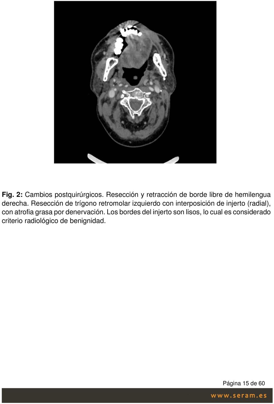 Resección de trígono retromolar izquierdo con interposición de injerto