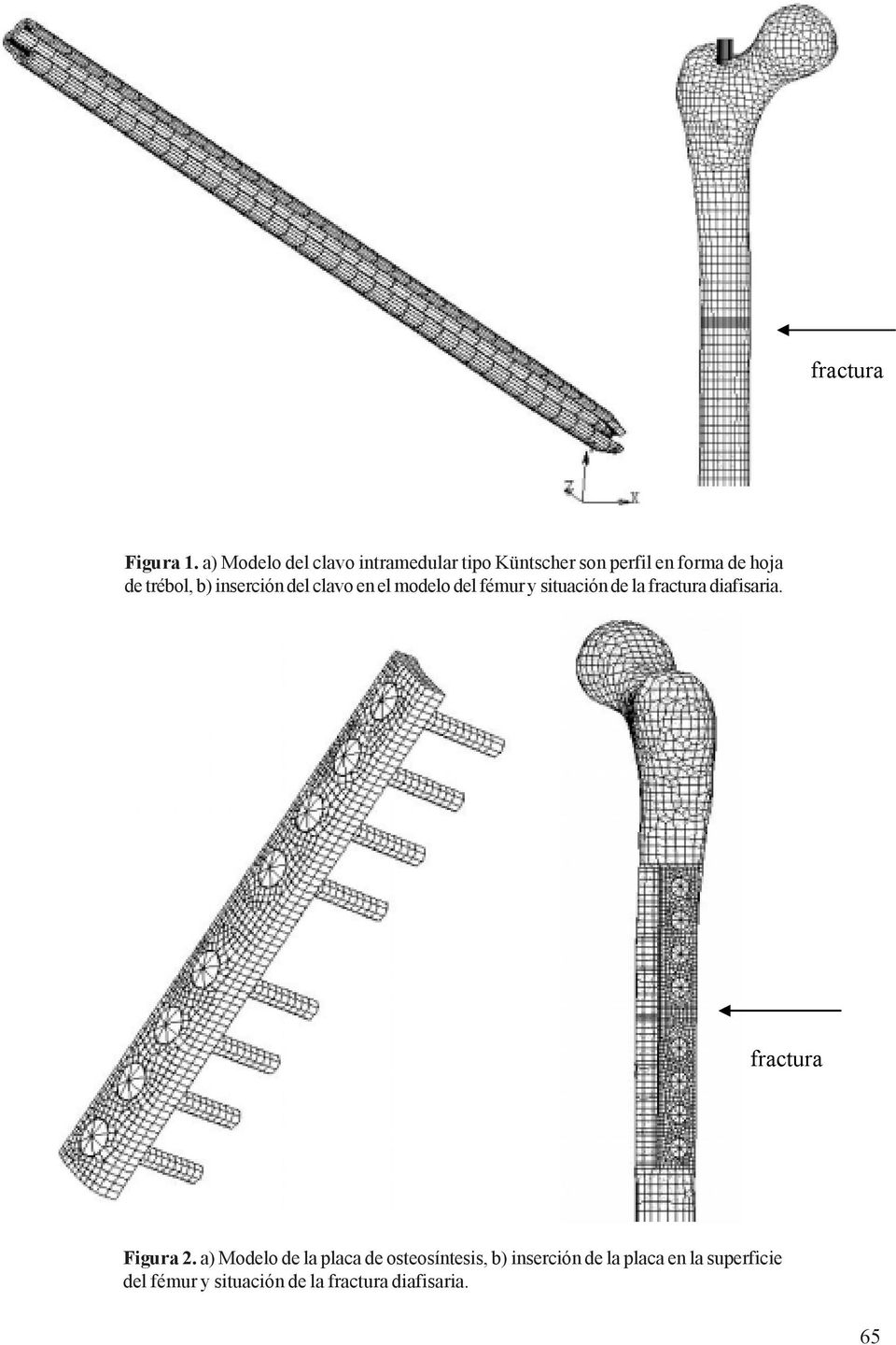 trébol, b) inserción del clavo en el modelo del fémur y situación de la fractura