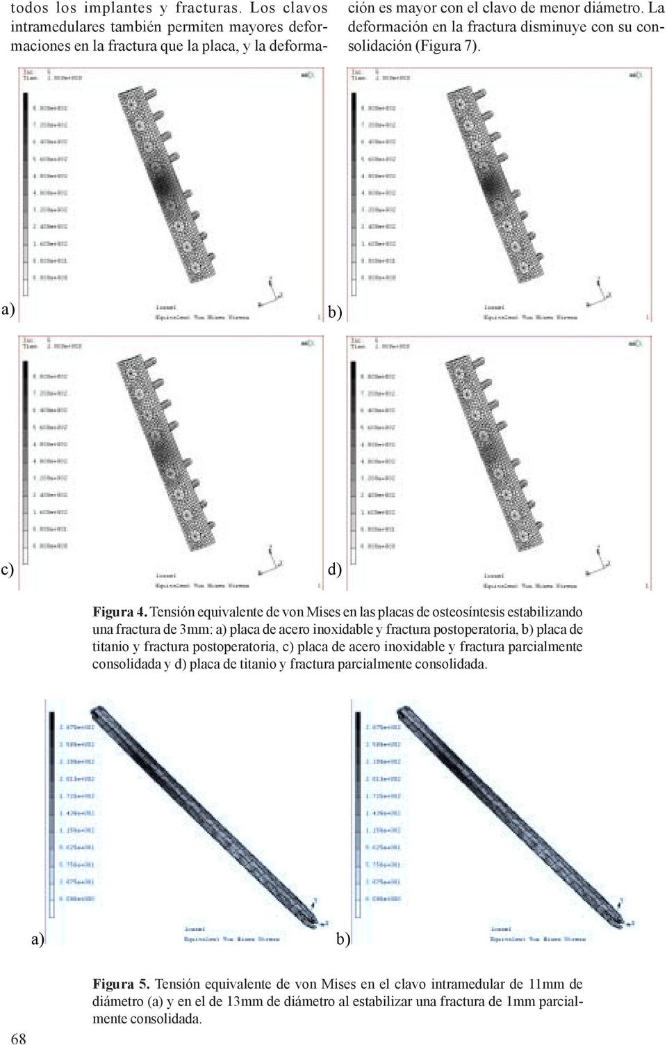 Tensión equivalente de von Mises en las s de osteosíntesis estabilizando una fractura de 3mm: a) de acero inoxidable y fractura postoperatoria, b) de titanio y fractura postoperatoria, c)