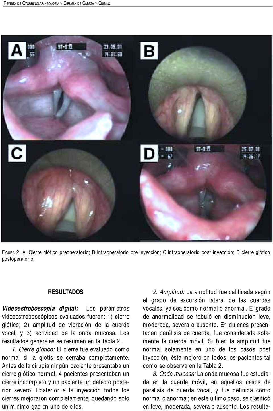 RESULTADOS Videoestroboscopía digital: Los parámetros videoestroboscópicos evaluados fueron: 1) cierre glótico; 2) amplitud de vibración de la cuerda vocal; y 3) actividad de la onda mucosa.