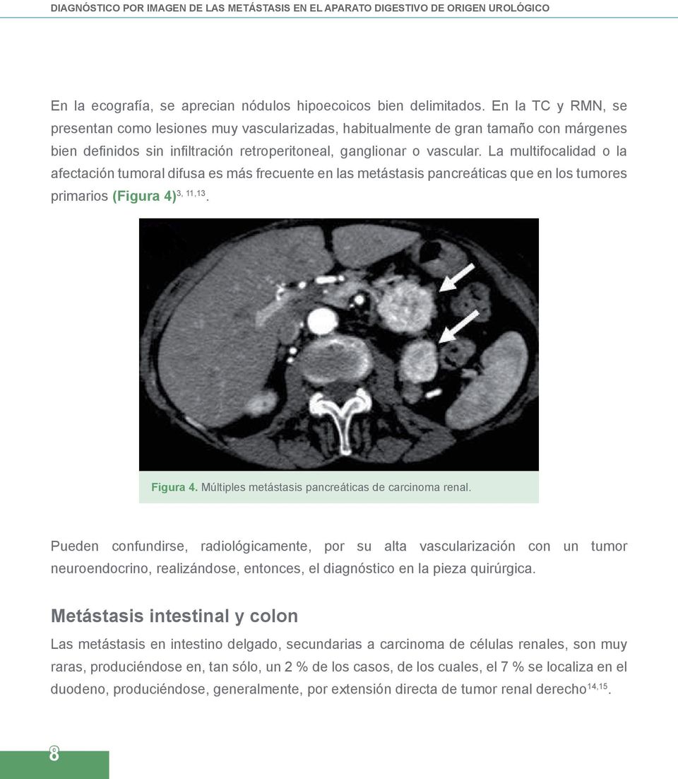 La multifocalidad o la afectación tumoral difusa es más frecuente en las metástasis pancreáticas que en los tumores primarios (Figura 4) 3, 11,13. Figura 4.