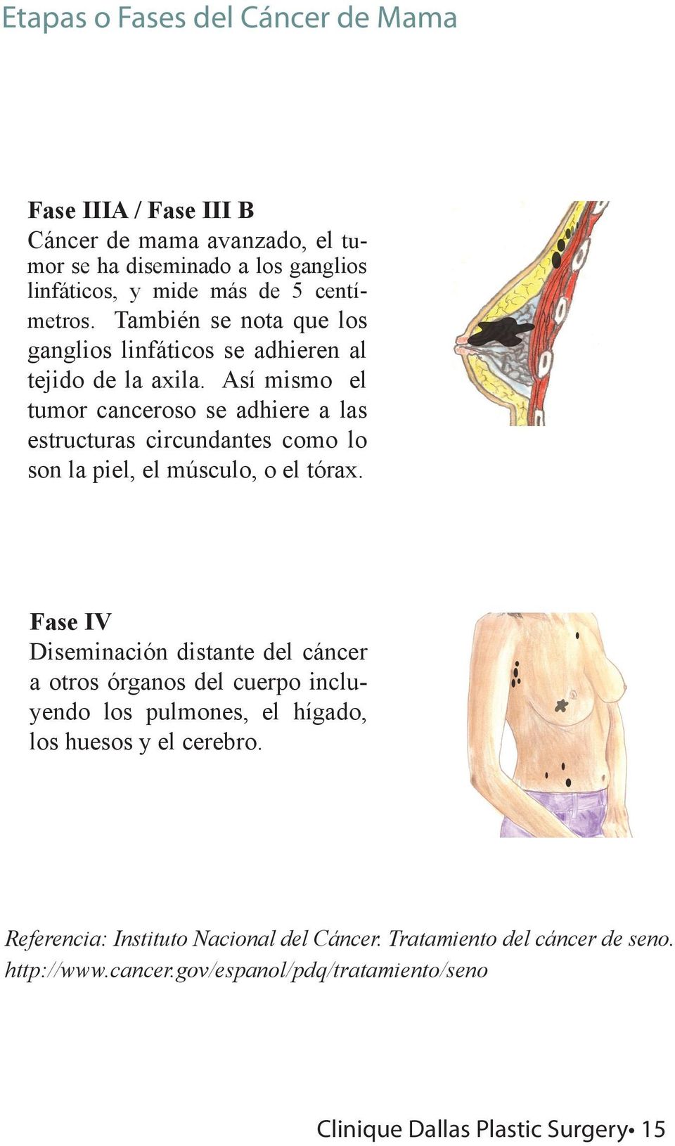 Así mismo el tumor canceroso se adhiere a las estructuras circundantes como lo son la piel, el músculo, o el tórax.