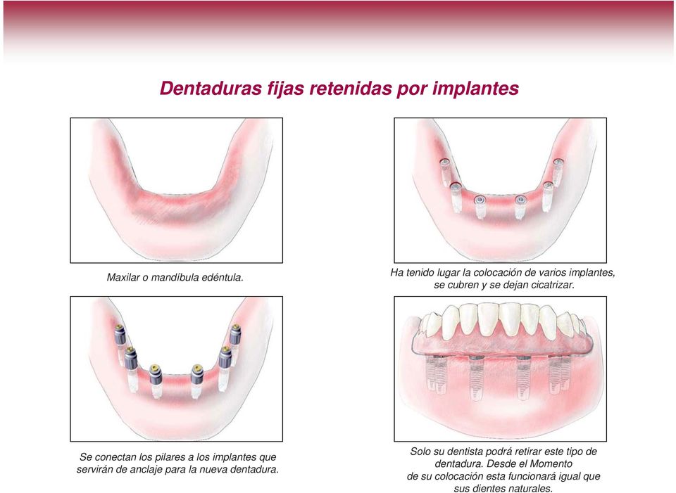 Se conectan los pilares a los implantes que servirán de anclaje para la nueva dentadura.