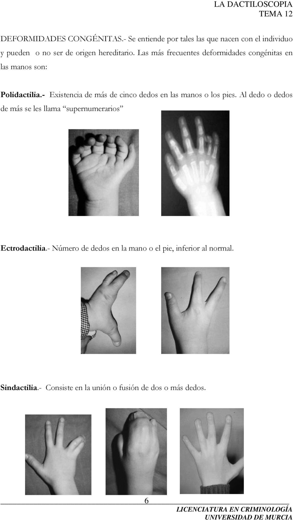 Las más frecuentes deformidades congénitas en las manos son: Polidactilia.