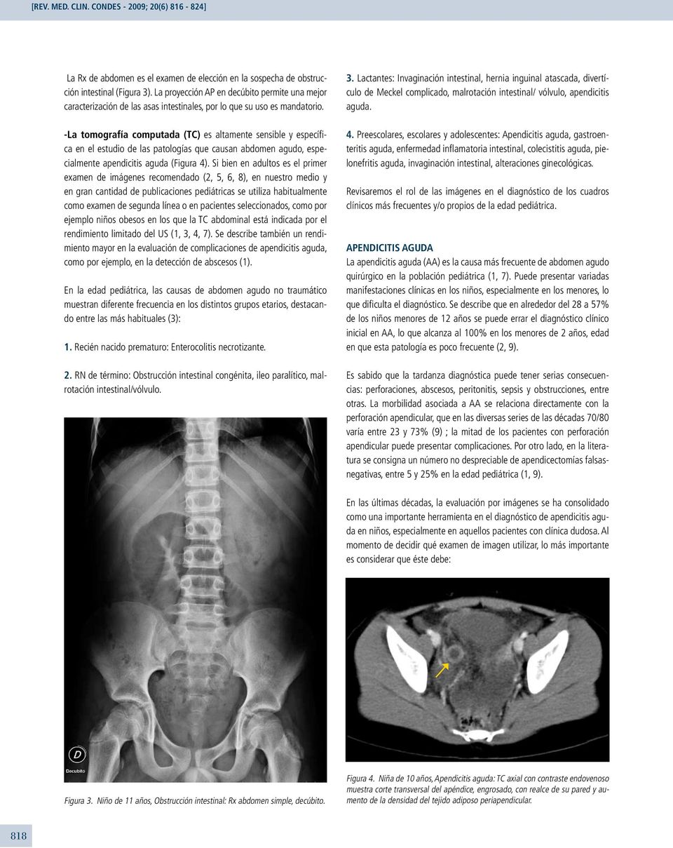 -La tomografía computada (TC) es altamente sensible y específica en el estudio de las patologías que causan abdomen agudo, especialmente apendicitis aguda (Figura 4).