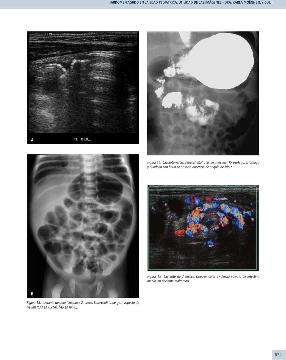 Malrotación intestinal: Rx esófago, estómago y duodeno con bario se observa ausencia de ángulo de Trietz.