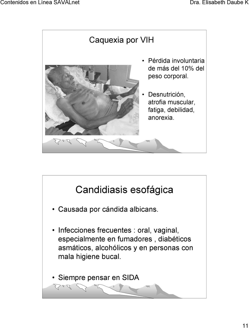 Candidiasis esofágica Causada por cándida albicans.