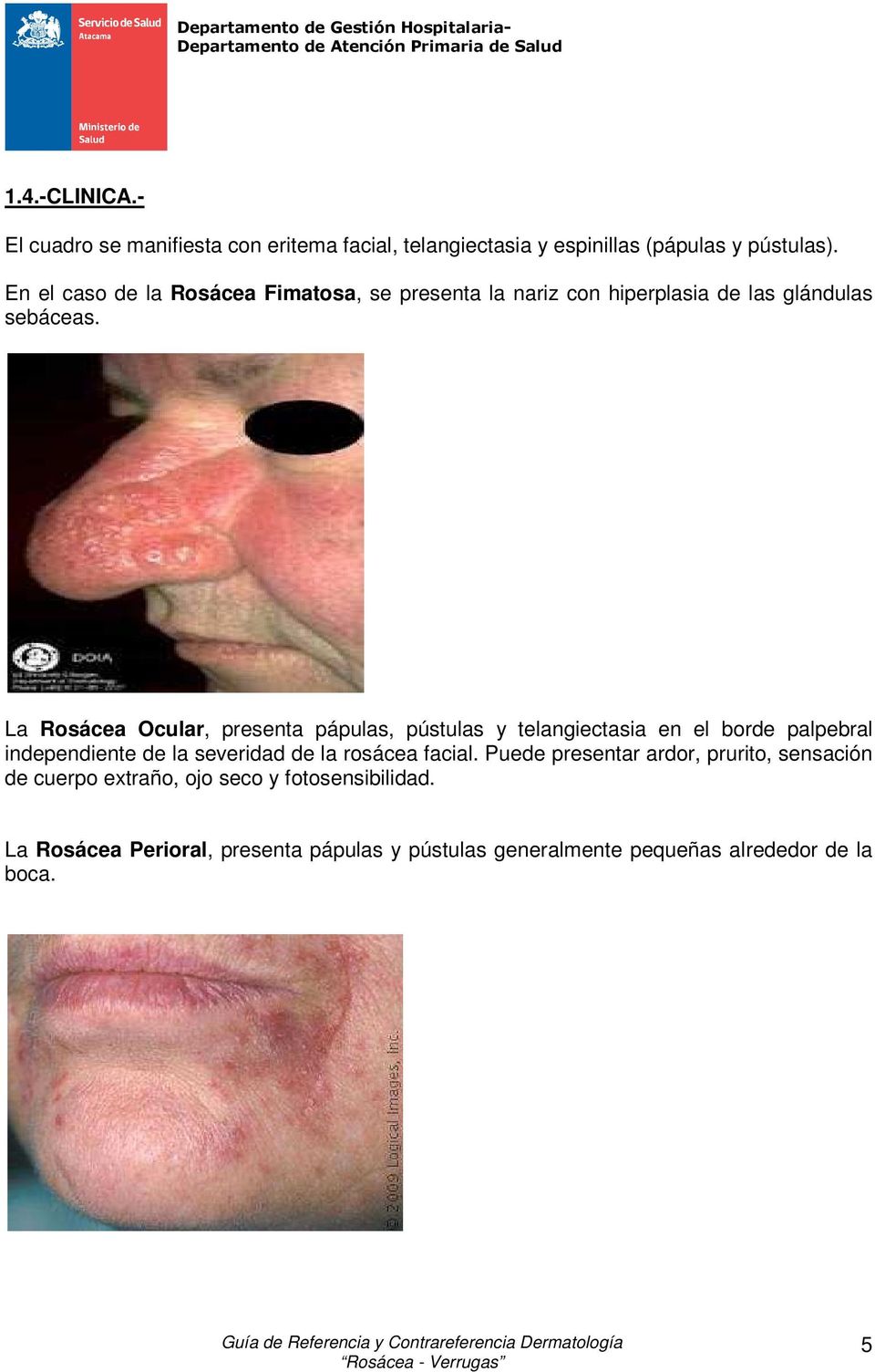 En el cas de la Rsácea Fimatsa, se presenta la nariz cn hiperplasia de las glándulas sebáceas.