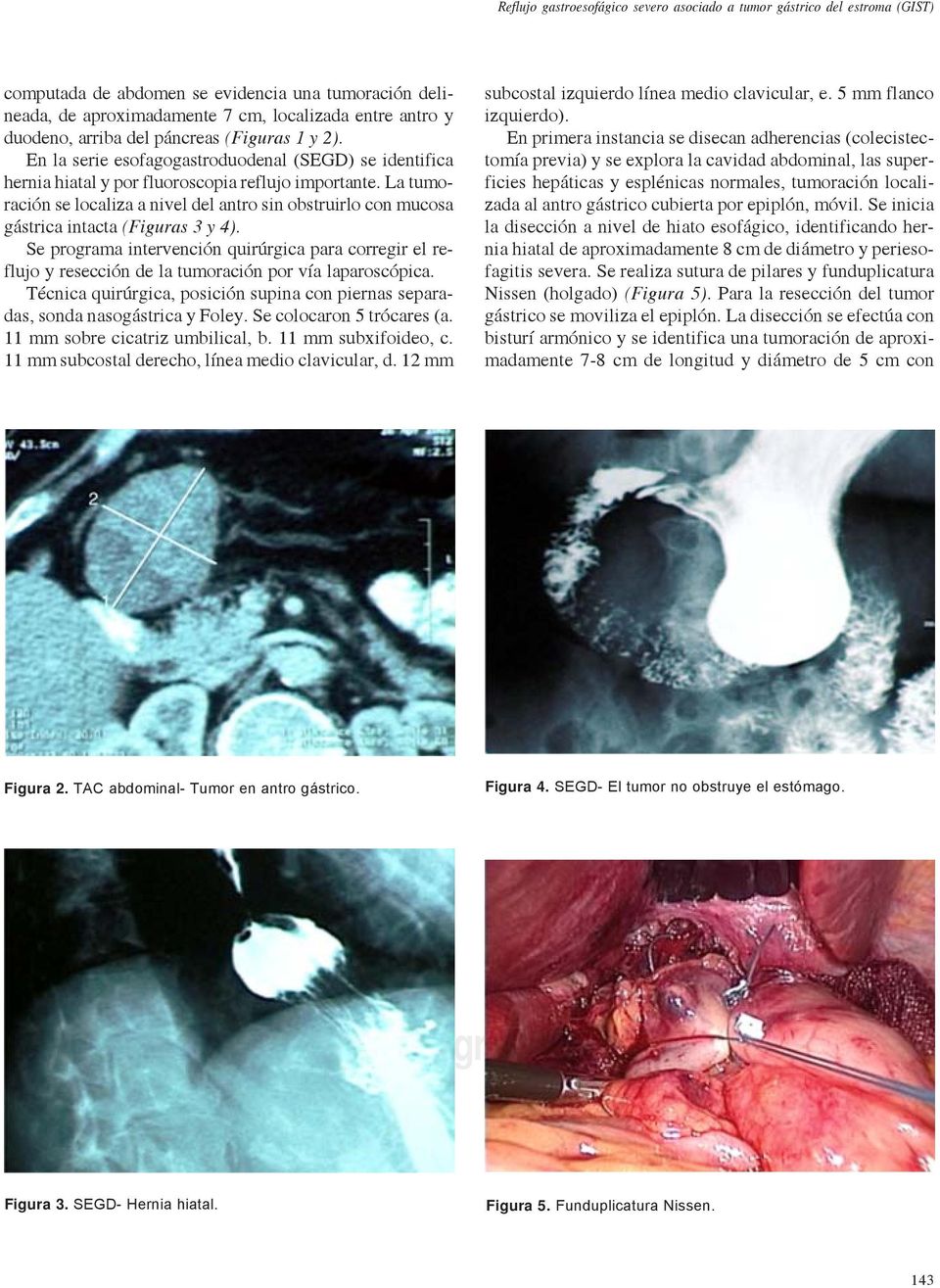 La tumoración se localiza a nivel del antro sin obstruirlo con mucosa gástrica intacta (Figuras 3 y 4).