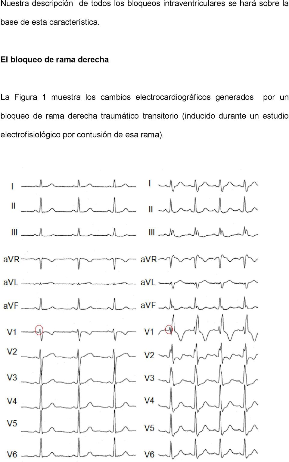El bloqueo de rama derecha La Figura 1 muestra los cambios electrocardiográficos