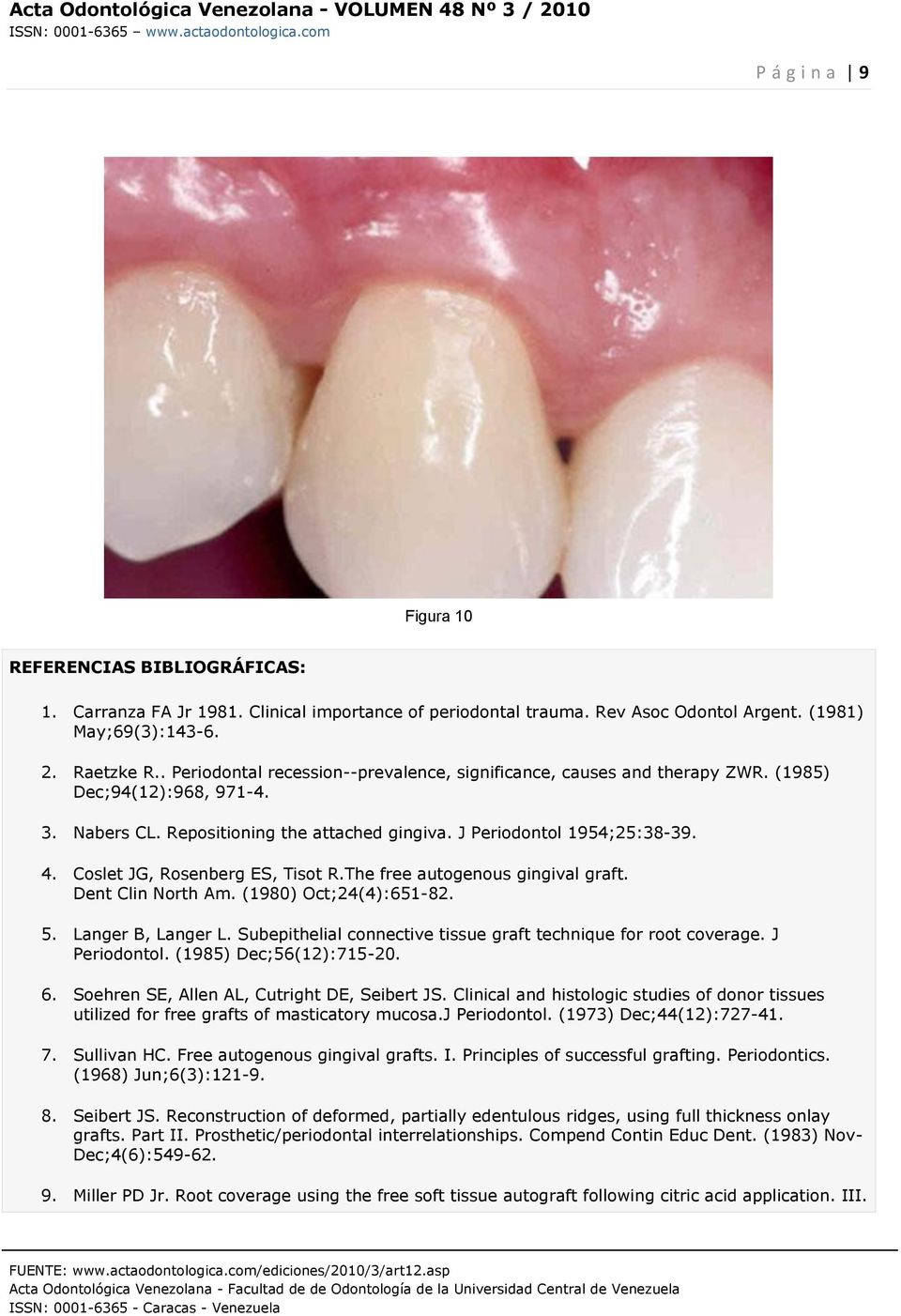 Coslet JG, Rosenberg ES, Tisot R.The free autogenous gingival graft. Dent Clin North Am. (1980) Oct;24(4):651-82. 5. Langer B, Langer L.