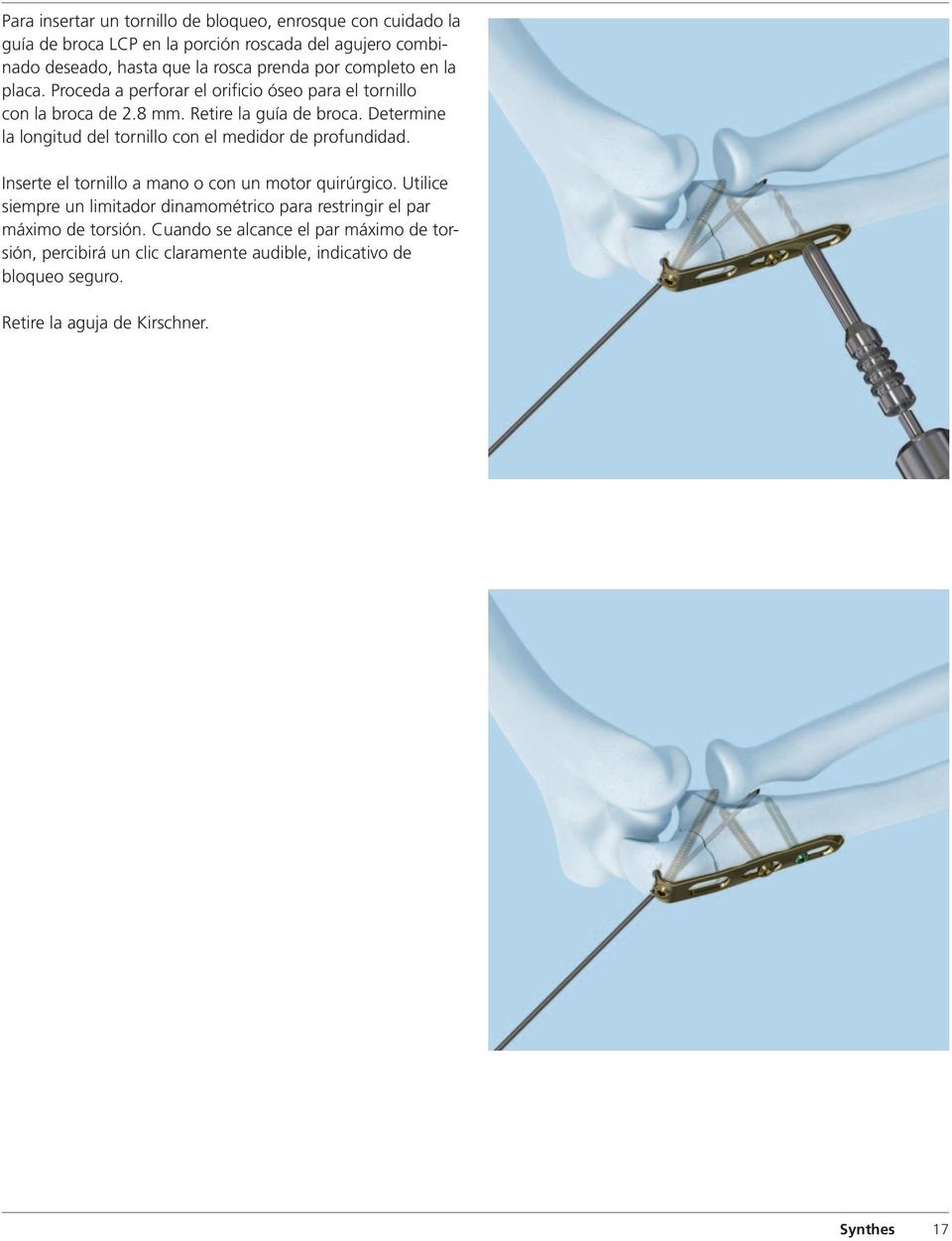 Determine la longitud del tornillo con el medidor de profundidad. Inserte el tornillo a mano o con un motor quirúrgico.