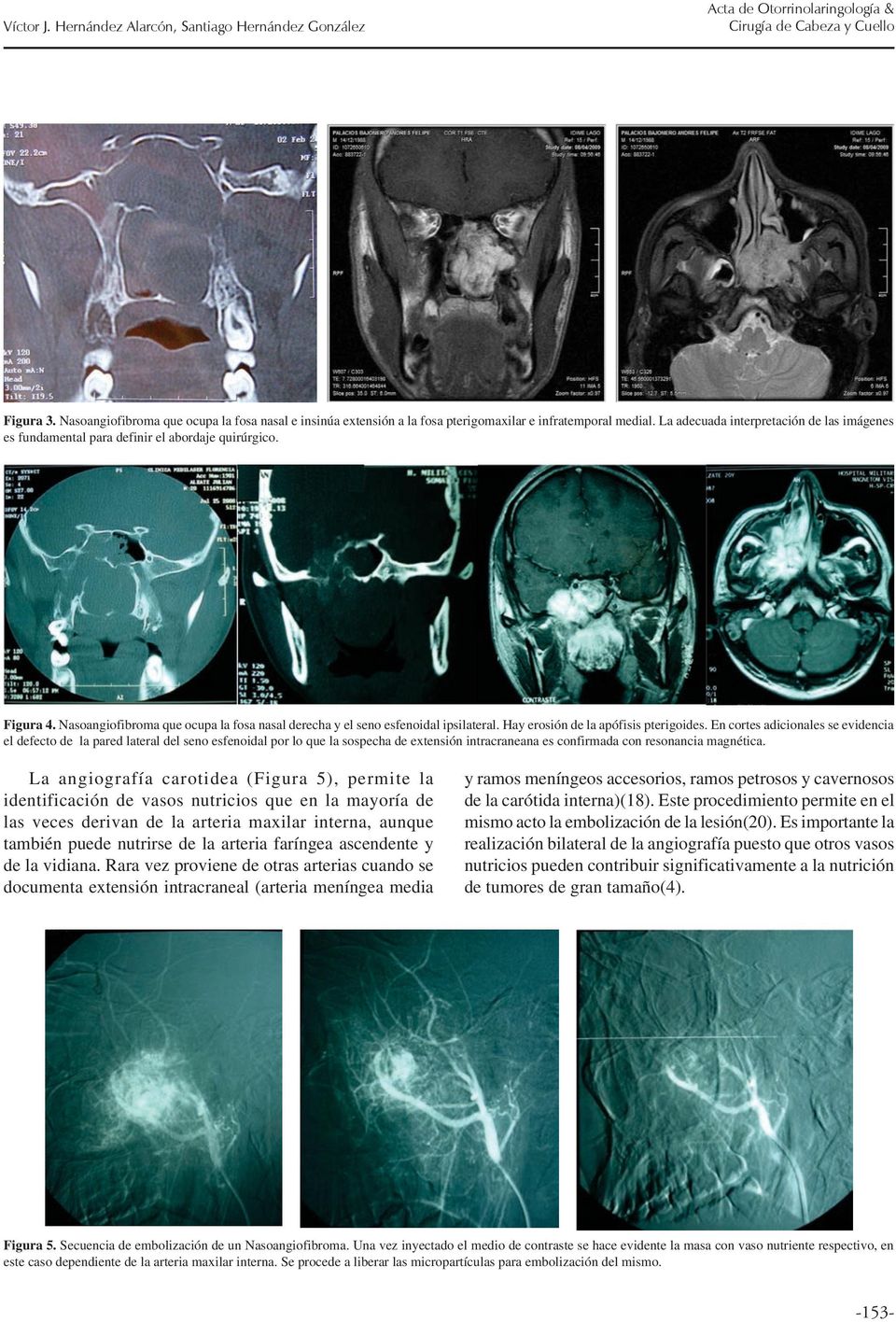 La adecuada interpretación de las imágenes es fundamental para definir el abordaje quirúrgico. Figura 4. Nasoangiofibroma que ocupa la fosa nasal derecha y el seno esfenoidal ipsilateral.