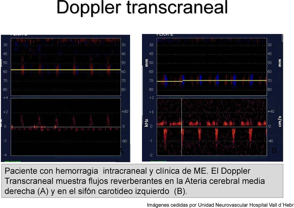 El Doppler Transcraneal muestra flujos reverberantes en la Ateria