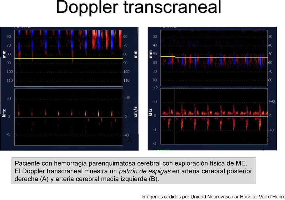 El Doppler transcraneal muestra un patrón de espigas en arteria cerebral
