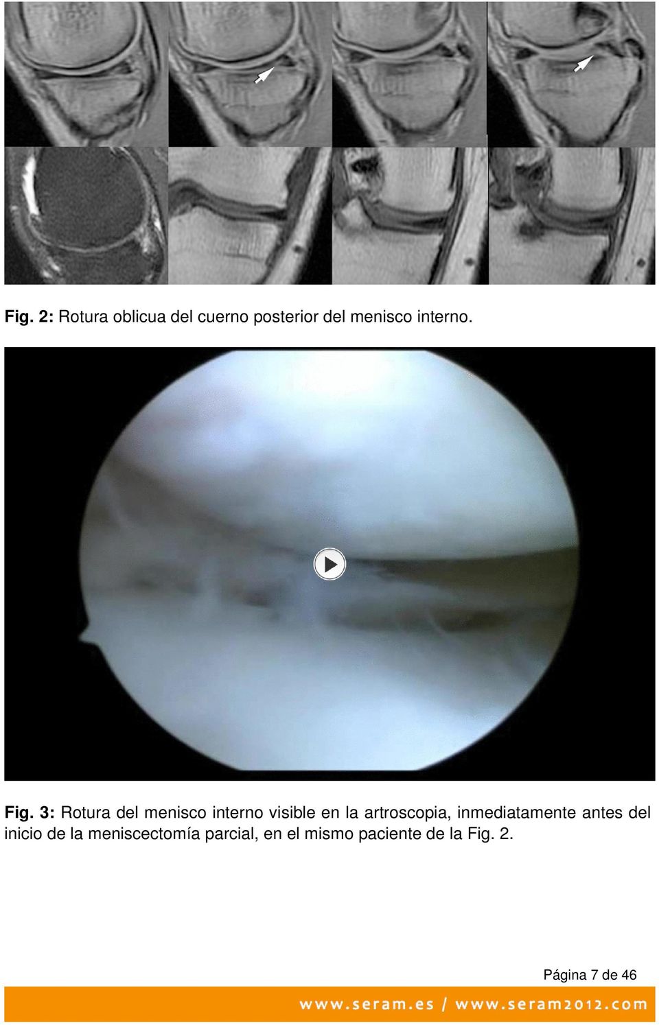 3: Rotura del menisco interno visible en la artroscopia,
