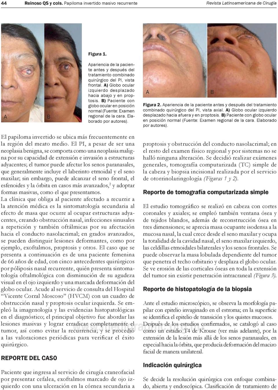 B) Paciente con globo ocular en posición normal (Fuente: Examen regional de la cara. Elaborado por autores). A Figura 2.