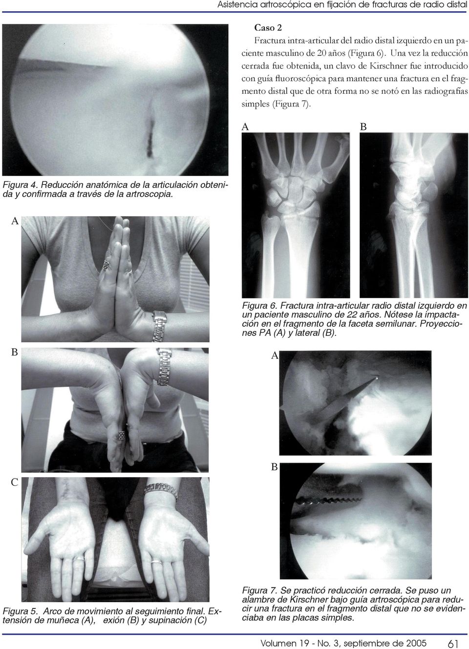 radiografías simples (Figura 7). Figura 4. Reducción anatómica de la articulación obtenida y confirmada a través de la artroscopia. Figura 6.