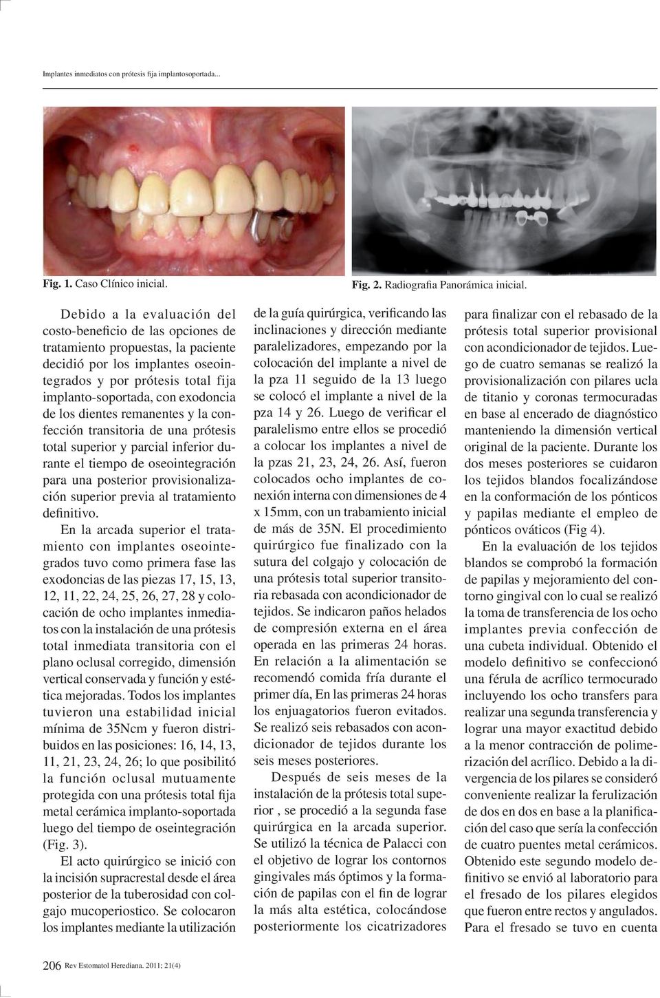 de los dientes remanentes y la confección transitoria de una prótesis total superior y parcial inferior durante el tiempo de oseointegración para una posterior provisionalización superior previa al