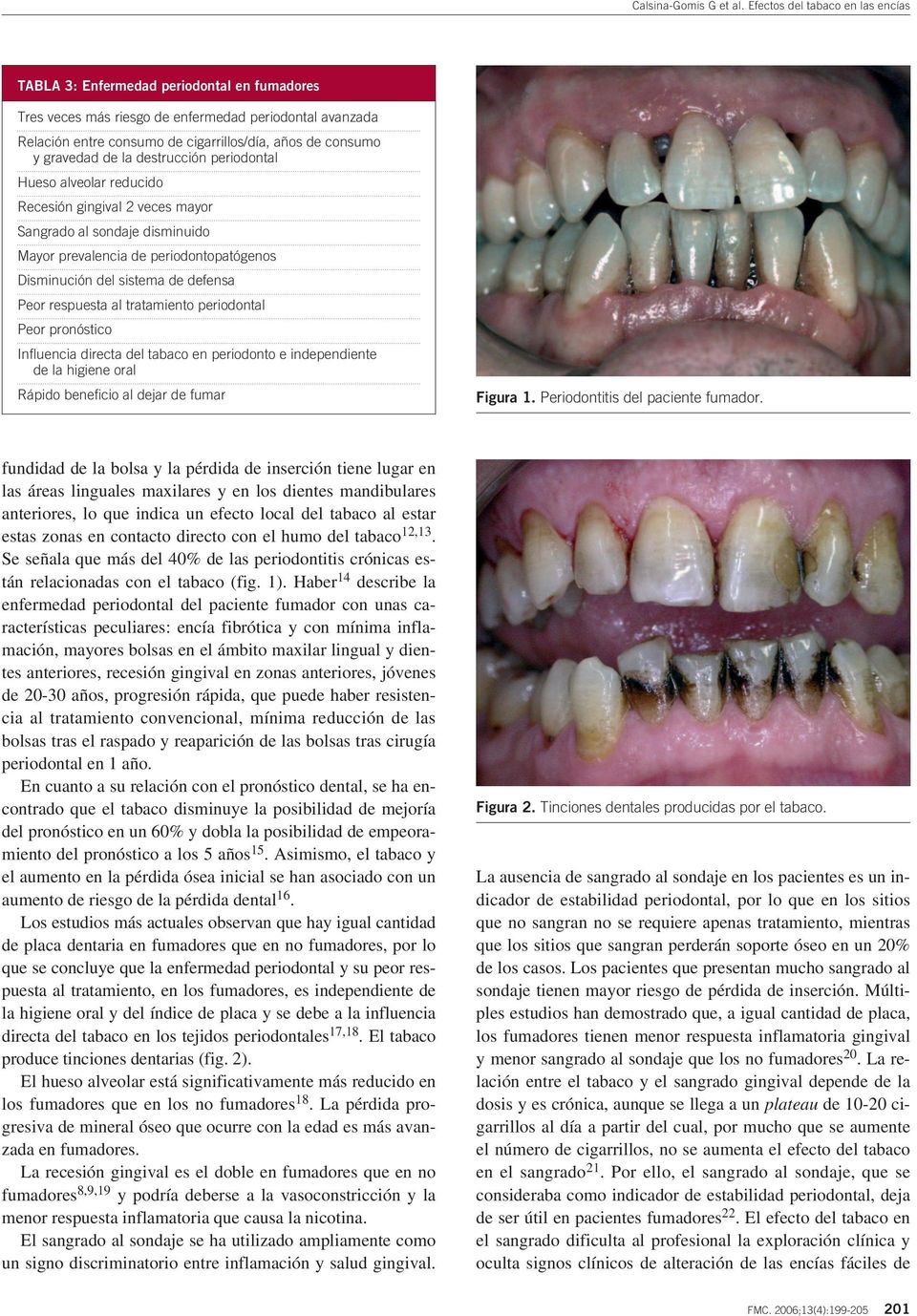 tratamiento periodontal Peor pronóstico Influencia directa del tabaco en periodonto e independiente de la higiene oral Rápido beneficio al dejar de fumar Figura 1. Periodontitis del paciente fumador.