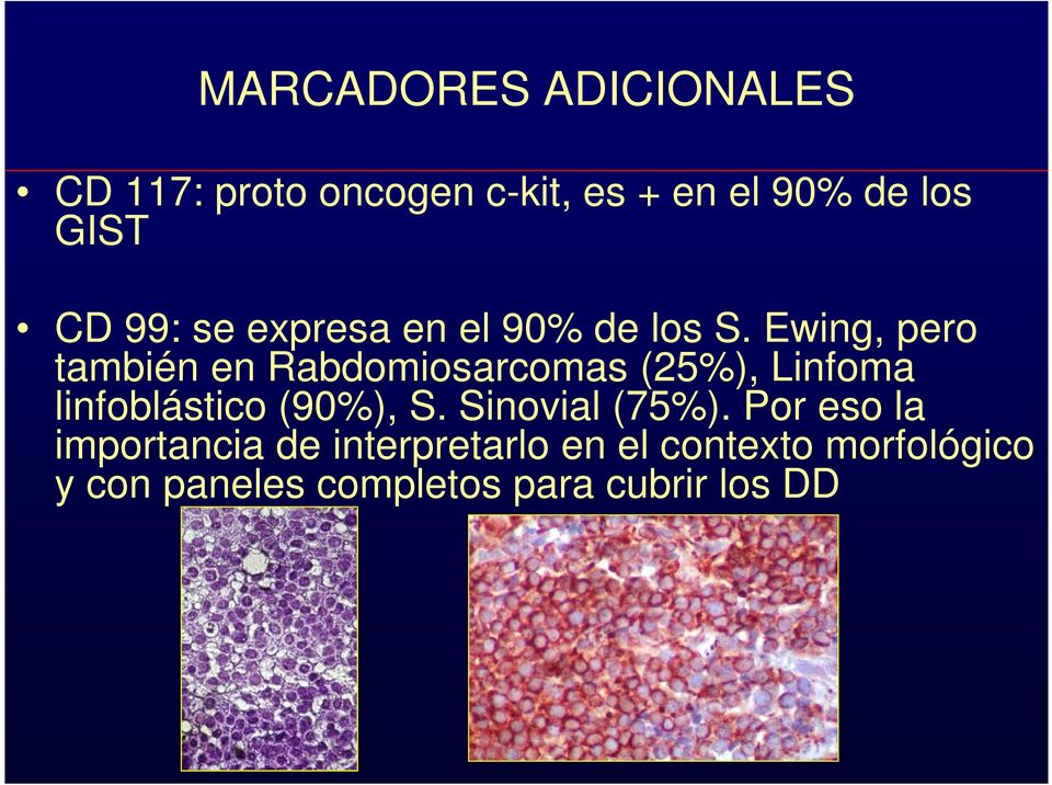 Ewing, pero también en Rabdomiosarcomas (25%), Linfoma linfoblástico (90%), S.
