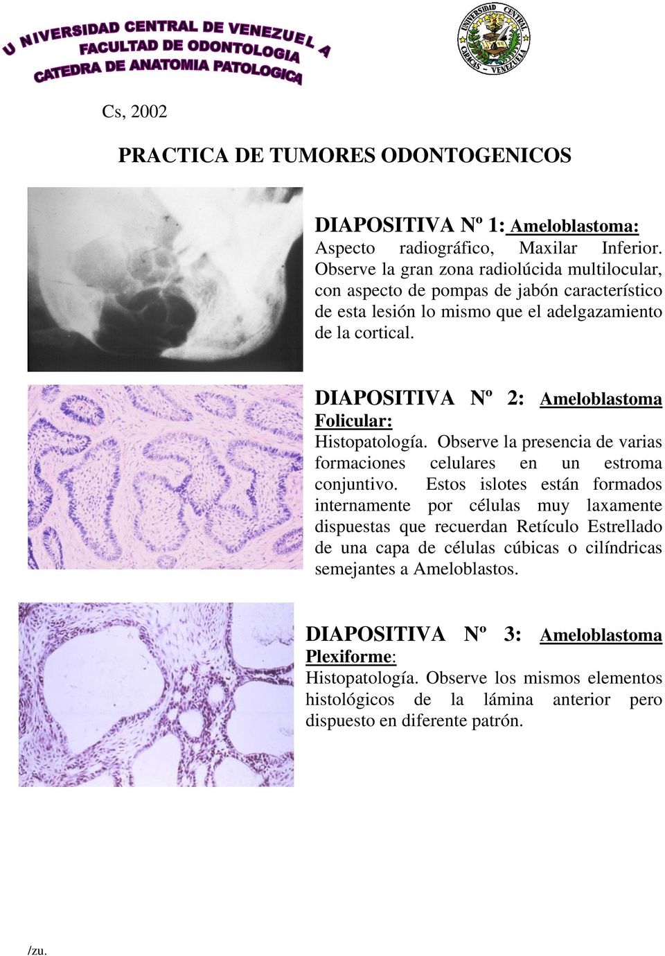 DIAPOSITIVA Nº 2: Ameloblastoma Folicular: Histopatología. Observe la presencia de varias formaciones celulares en un estroma conjuntivo.