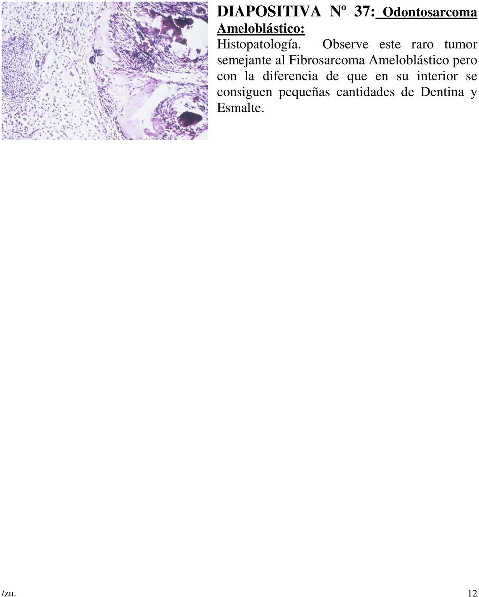 Observe este raro tumor semejante al Fibrosarcoma